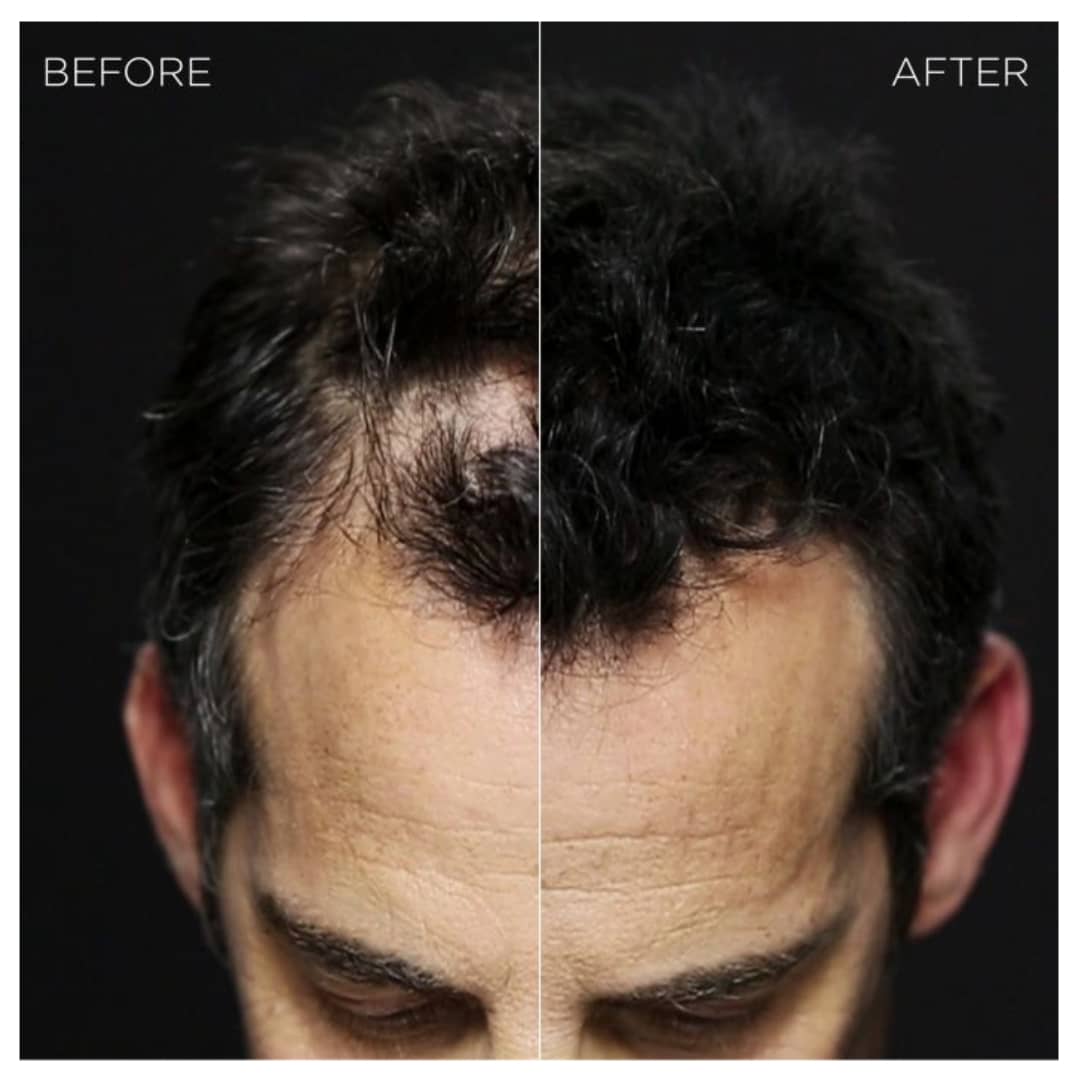 Prima e dopo toppik capelli uomo